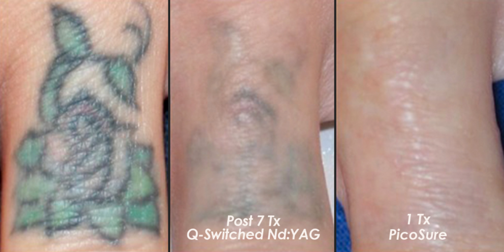 Laser Tattoo Removal Method  Things You Should Know