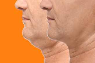 Non Surgical Double Chin Treatment at El Centro Dermatology